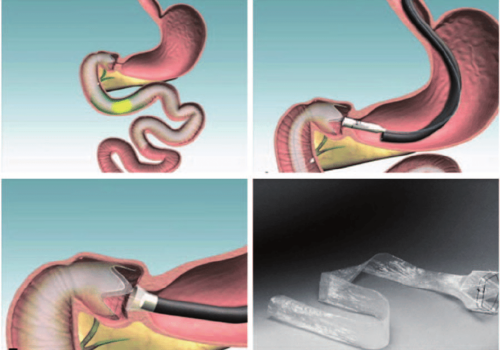 A-duodenal-jejunal-bypass-sleeve-EndoBarrier-made-from-a-Teflon-liner-and-delivered