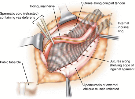 Inguinal Hernia Repair – GBMC Jordan