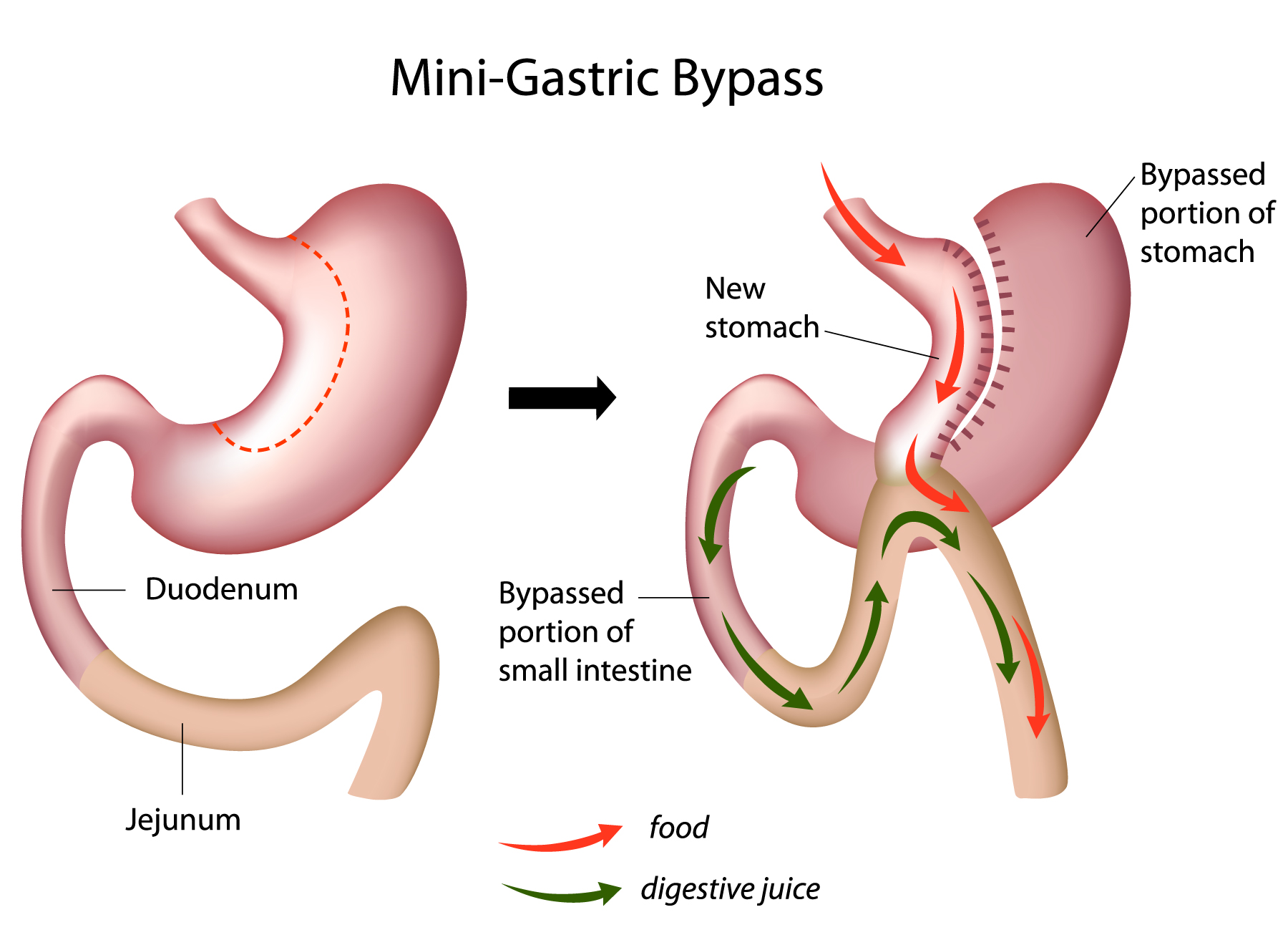 Laparoscopic One Anastomosis Gastric Bypass Oagb Mgb Gbmc Jordan