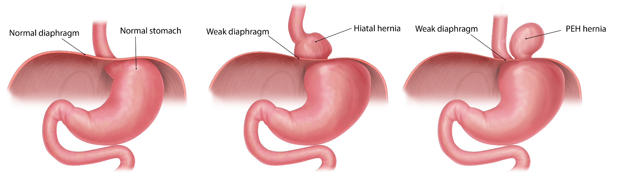 Diagram Of Hiatal Hernia