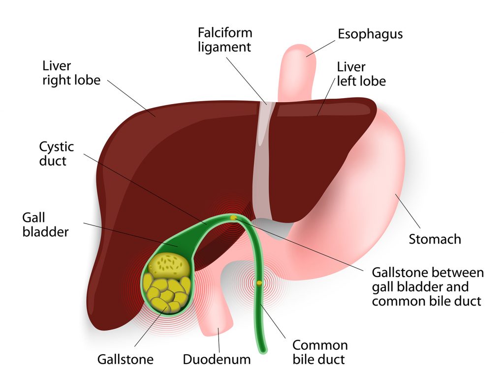 Stones in Gallbladder & Common Bile Duct – GBMC Jordan