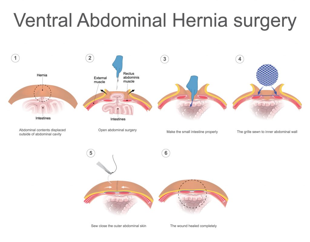 Ventral Hernia Abdomen